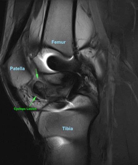 ACL Surgery Cyclops Lesions LaptrinhX News