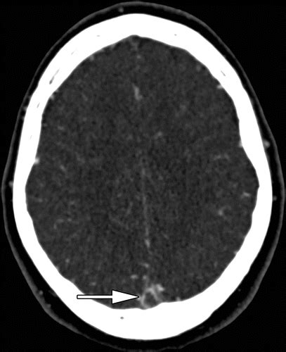 Radiologic Clues To Cerebral Venous Thrombosis Radiographics