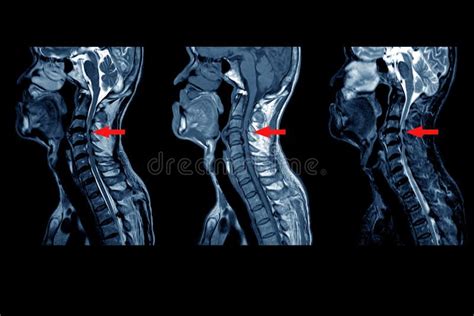 MRI of CERVICAL SPINE : Moderate To Severe Posterior Central Disc Protrusion of C3/4 To C5/6 ...