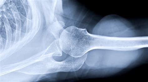 X Ray Shoulder Joint Shoulder Transaxillary View For Diagnosis Fracture