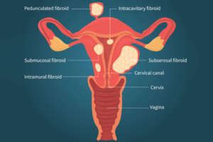 Best Treatment For Uterine Fibroids Antai Hospital Antai Hospital