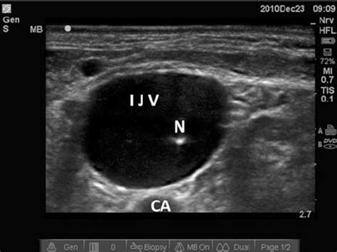 Short Axis Views Of The Internal Jugular Vein And Sur Rounding Download Scientific Diagram