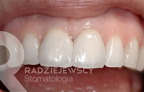 Metamorfozy Stomatologia Radziejewscy Ortodoncja I Nak Adki Invisalign