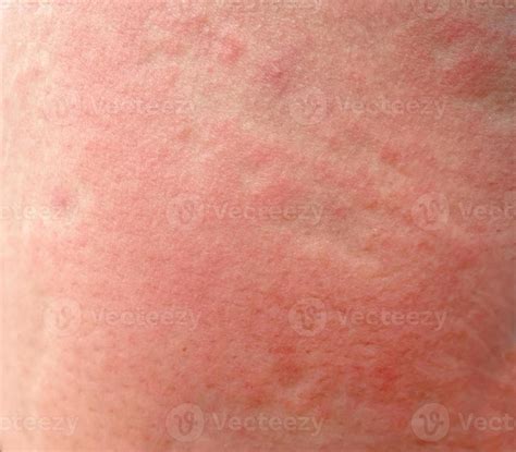 Rash On Thigh