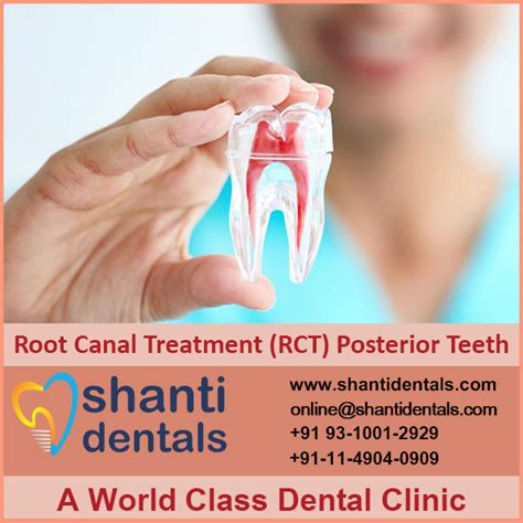 Root Canal Treatment RCT Posterior Teeth Shanti Dentals