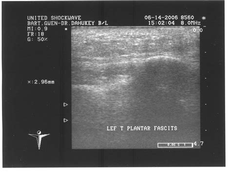 Plantar Fascia Ultrasound