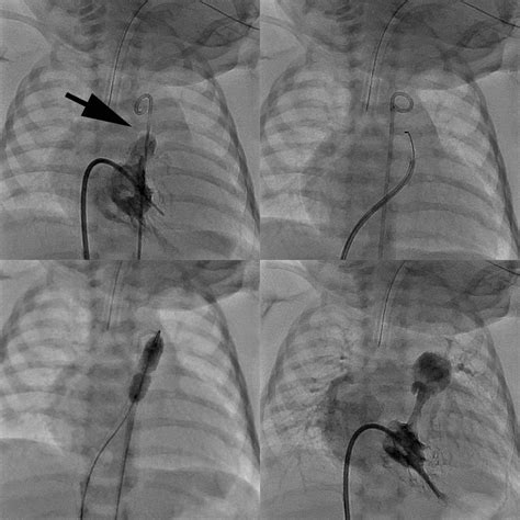 Cardiac Catheterization Program Pediatrics