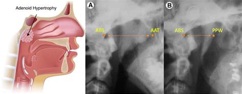 adenoid-hypertrophy