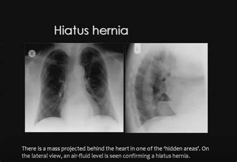 Incarcerated Hiatus Hernia Hiatus Hernia X Ray Fluid