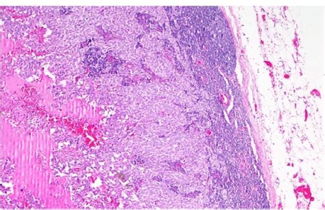 Vulvar Melanoma Management Of Primary Disease And Repeated Recurrences International Journal