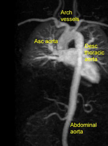 MR Aortogram All About Cardiovascular System And Disorders