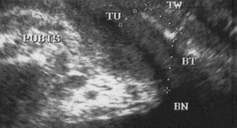 Clinical And Ultrasonographic Comparison Of Tension Free Vaginal Tape