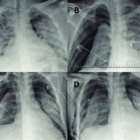 Posterior Anterior Chest X Ray A Widespread Consolidated Areas In