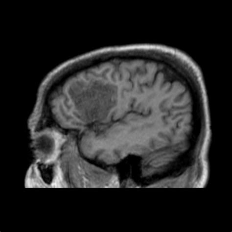 Subacute Cerebral Infarction With Mr Spectroscopy Image