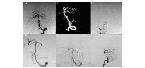 A Digital Subtraction Angiography Dsa And B 3d Dsa Images Showing