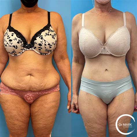 Plastic Surgery Body Results Before And After Gallery Dr Mark Markarian