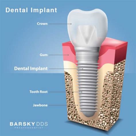 Dental Implant Tooth Root Jawbone Diagram Barsky Dds 1 Todd B Barsky