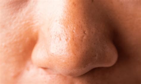 Large Pores On Nose Treatment