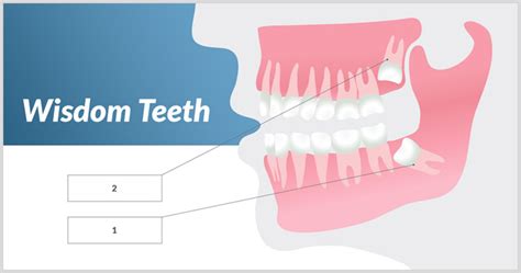 Wisdom Tooth Removal Neutral Bay Dentist