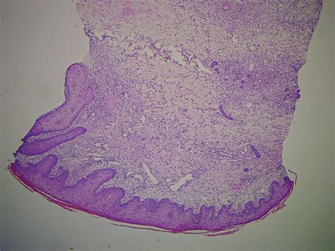 Numerous Dilated Vessels With Moderate Dermal Inflammatory Infiltrate Download Scientific Diagram