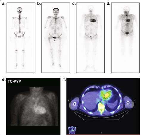 Assessments For Noninvasive Diagnosis Of Attr Amyloidosis A D M