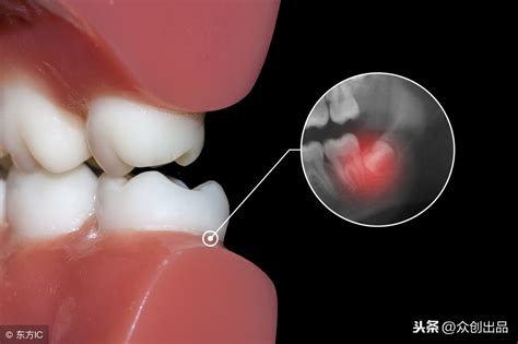 长智齿是什么原因智齿是怎样形成的什么年纪容易长智齿怎样正确处理智齿呢 说明书网