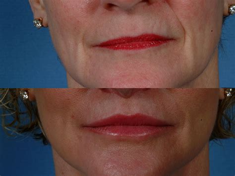 Mouth Corner Lip Lift Champaign Lip Augmentation Surgery Il