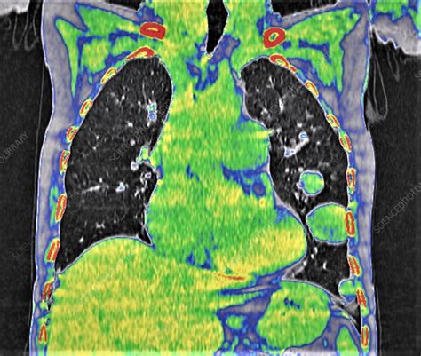 Cannonball pulmonary metastases, CT scan - Stock Image - F034/8222 ...