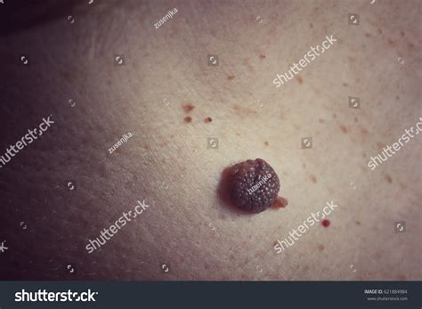 "epidermal_nevus" Images, Stock Photos & Vectors | Shutterstock