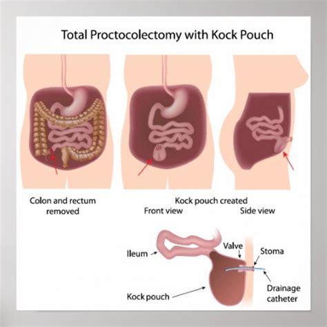 Total proctocolectomy with Kock pouch poster | Zazzle