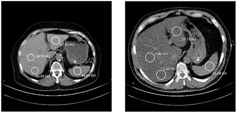 Normal Liver Ct Scan