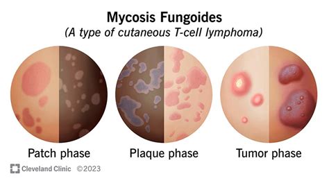 Mycosis Fungoides: Symptoms And Treatment, 42% OFF