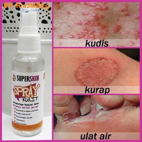 New Ubat Kurap 🔥 Gatal Kayap Ruam Ekzema Kudis Psoriasis Scabies Itchy