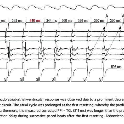 Pdf Analyses Of The Mode Of Termination During Diagnostic Ventricular Pacing To Differentiate