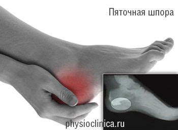 Лечение пяточной шпоры - цена от 950 руб.