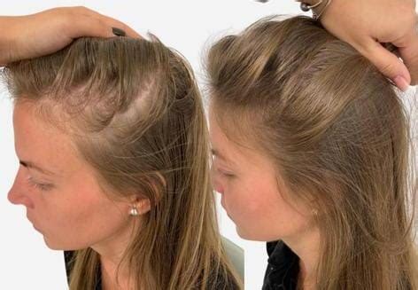 Understanding Female Hair Loss Causes Treatment Jo Cosmetic