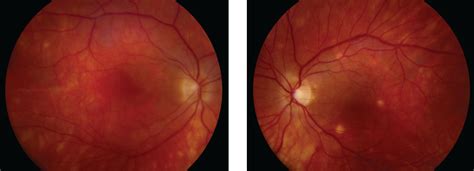 Birdshot Chorioretinopathy