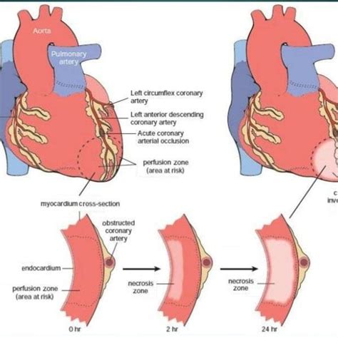 Pathophysiology of acute myocardial infarction | Download Scientific ...