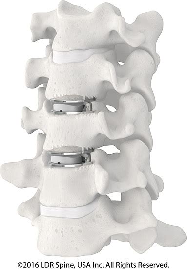 Cervical Disc Replacement Des Plaines Il Spinal Fusion Surgery