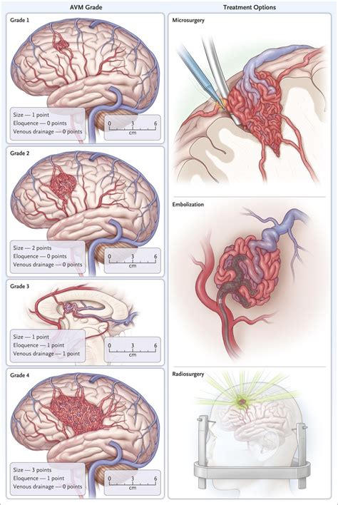 Avm Brain Symptoms