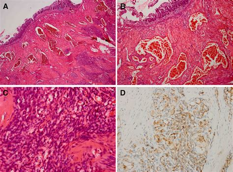 Photomicrographs Of Kaposiform Hemangioendothelioma Involving Ileum And