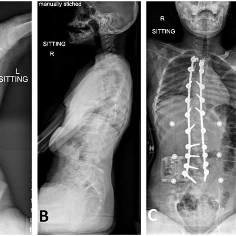 Preoperative Antero Posterior A And Lateral B Radiographs Of A Download Scientific Diagram