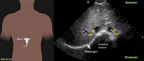 Inferior Vena Cava Pocus The Basics Of Image Acquisition Renal