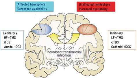 Non Invasive Brain Stimulation Tms Tdcs And Rehabilitation For Stroke