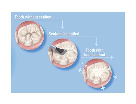 What Are Dental Sealants And How Do They Help