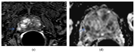 Life Free Full Text Prostate Mri Is Endorectal Coil Necessary—a Review