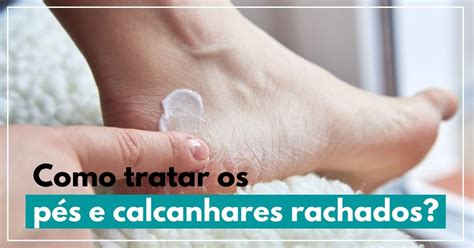 Como tratar os pés e calcanhares rachados Pharma Scalabis