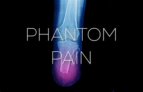 Phantom Pain After Amputation