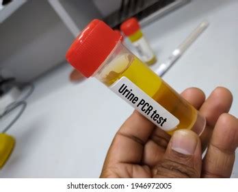 Urine Sample Urine Pcrprotein Creatinine Ratio Test Stock Photo