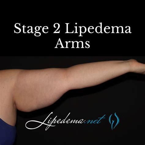 Learn About Stages and Types of Lipedema | Lipedema.net